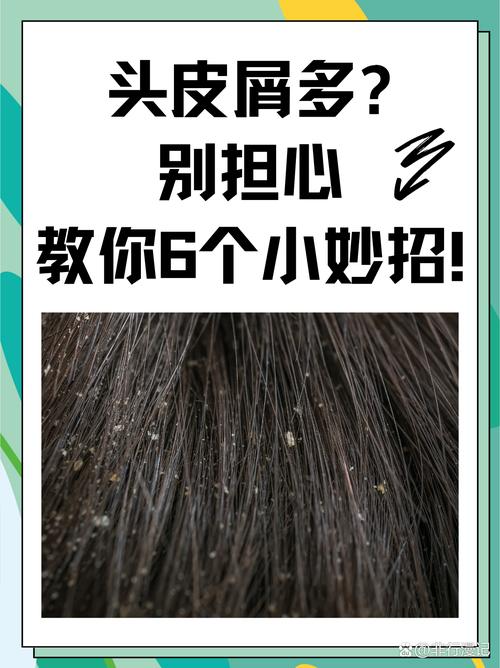 头皮屑多会传染给家人吗？预防头皮屑传染的有效方法是什么？